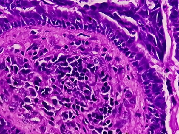 AACR Special Conferences Gather Investigators Advancing Research on Gynecologic Cancers  